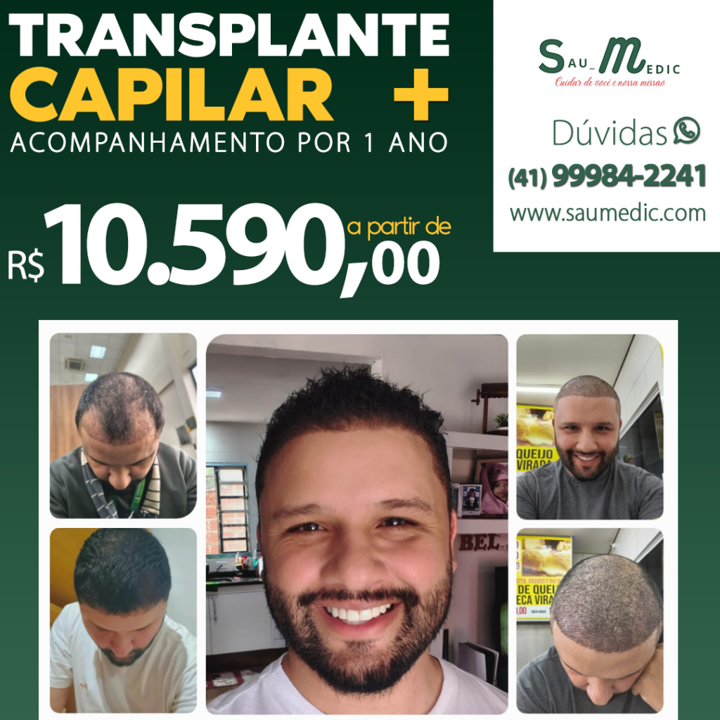 Saumedic Transplante Capilar: tecnologia moderna para recuperar os cabelos